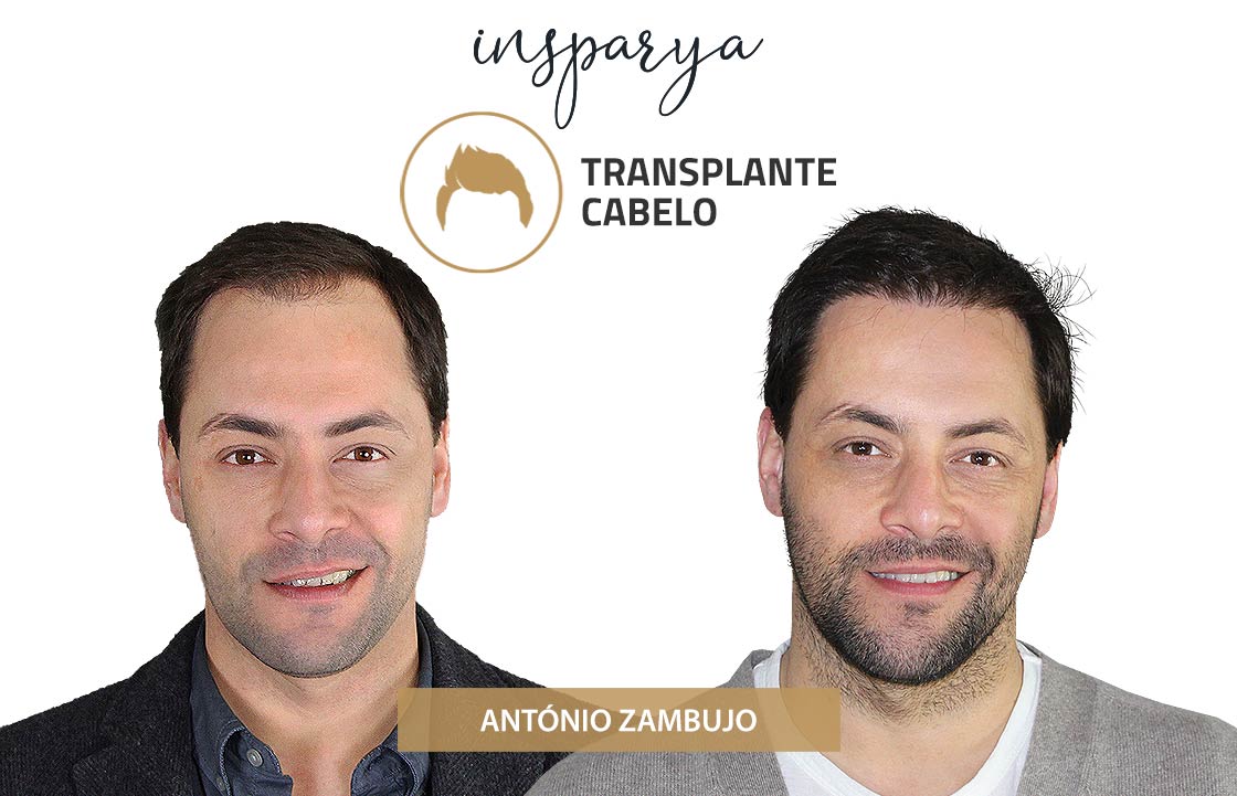 Transplante Capilar Antes e Depois, António Zambujo