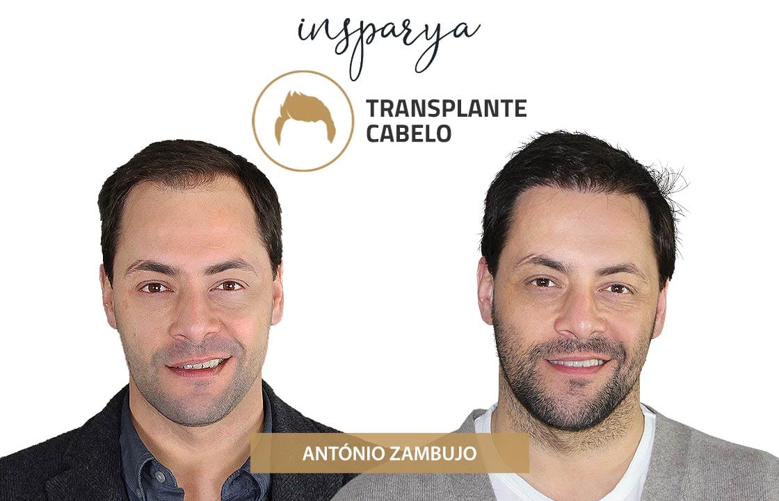 António Zambujo – Transplante Capilar, Antes e Depois Transplante Capilar Antes e Depois, António Zambujo