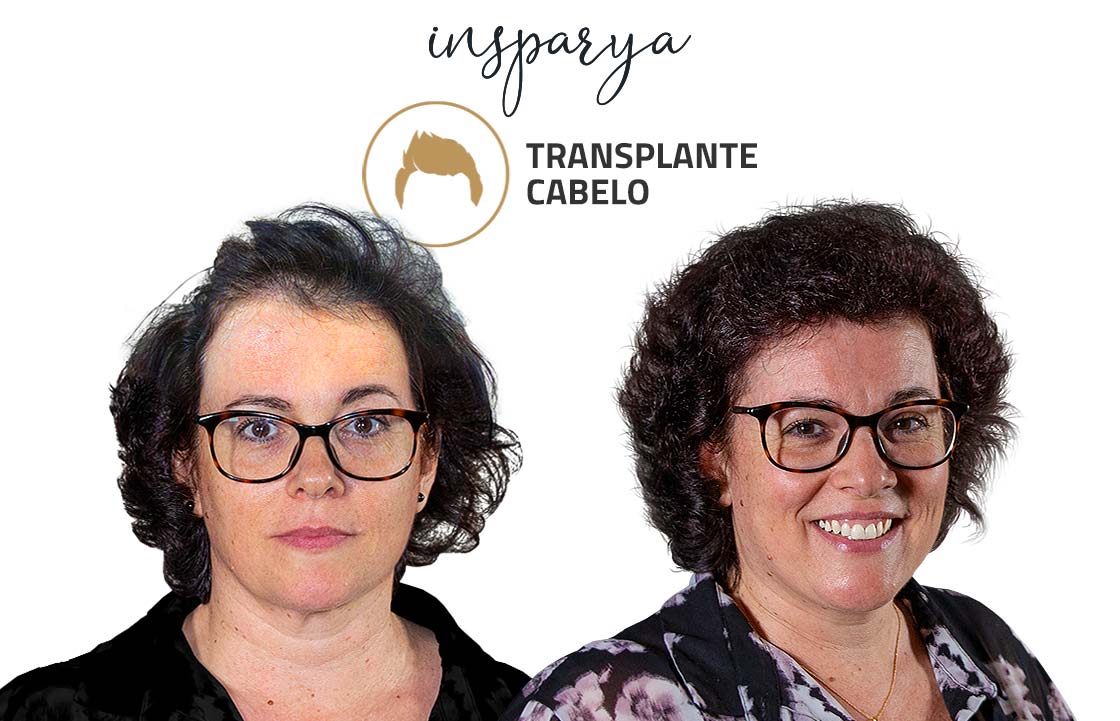 Transplante Capilar Antes e Depois, Carla Quintanilho