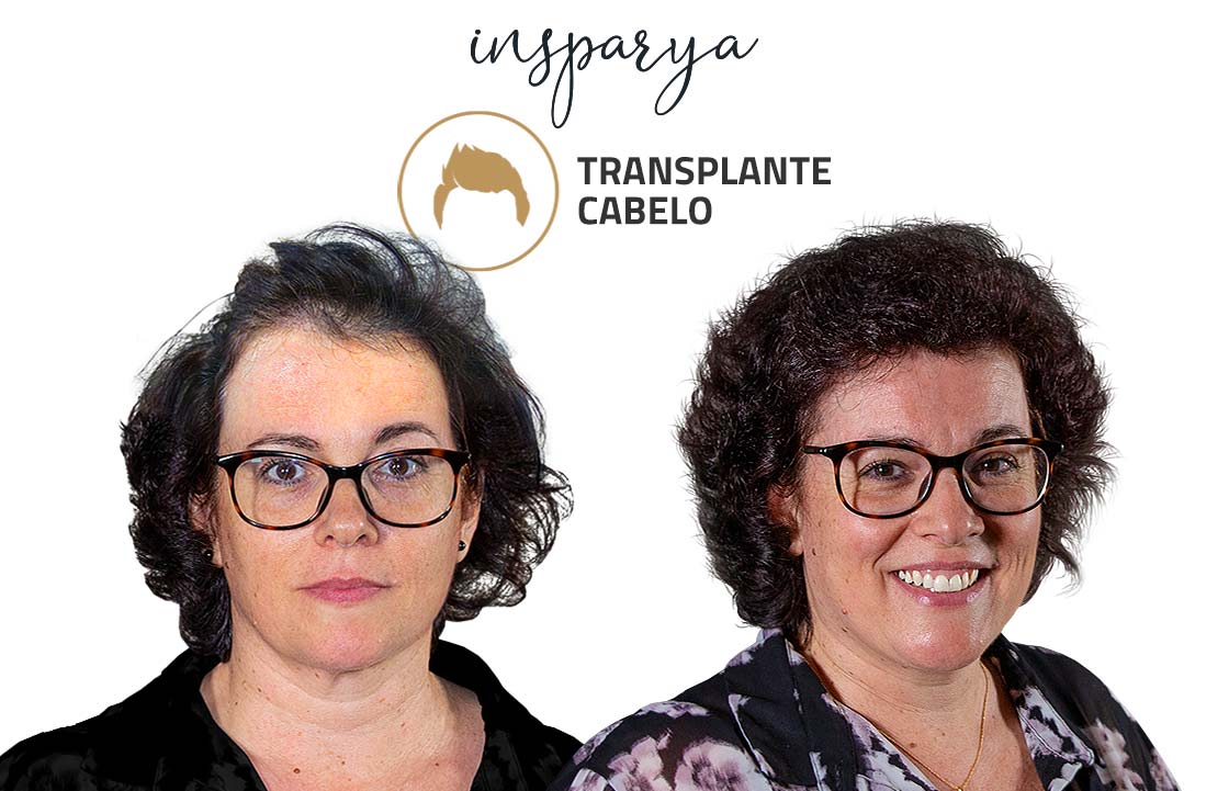 Carla Quintanilho – Transplante Capilar, Antes e Depois Transplante Capilar Antes e Depois, Carla Quintanilho