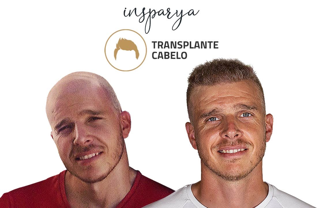 Transplante Capilar Antes e Depois, Dinis Gonçalves