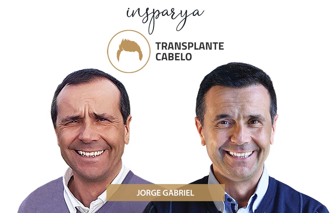Transplante Capilar Antes e Depois, Jorge Gabriel