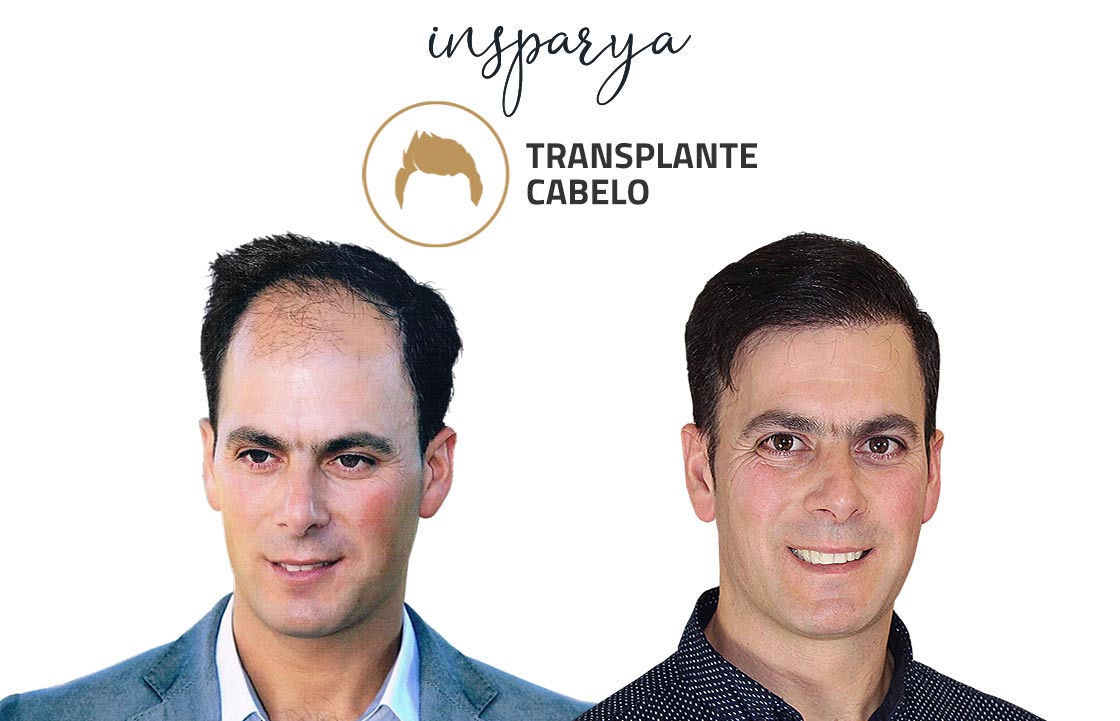 Transplante Capilar Antes e Depois, José Gavina
