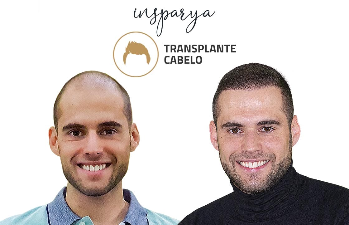 Transplante Capilar Antes e Depois, Leandro Fernandes