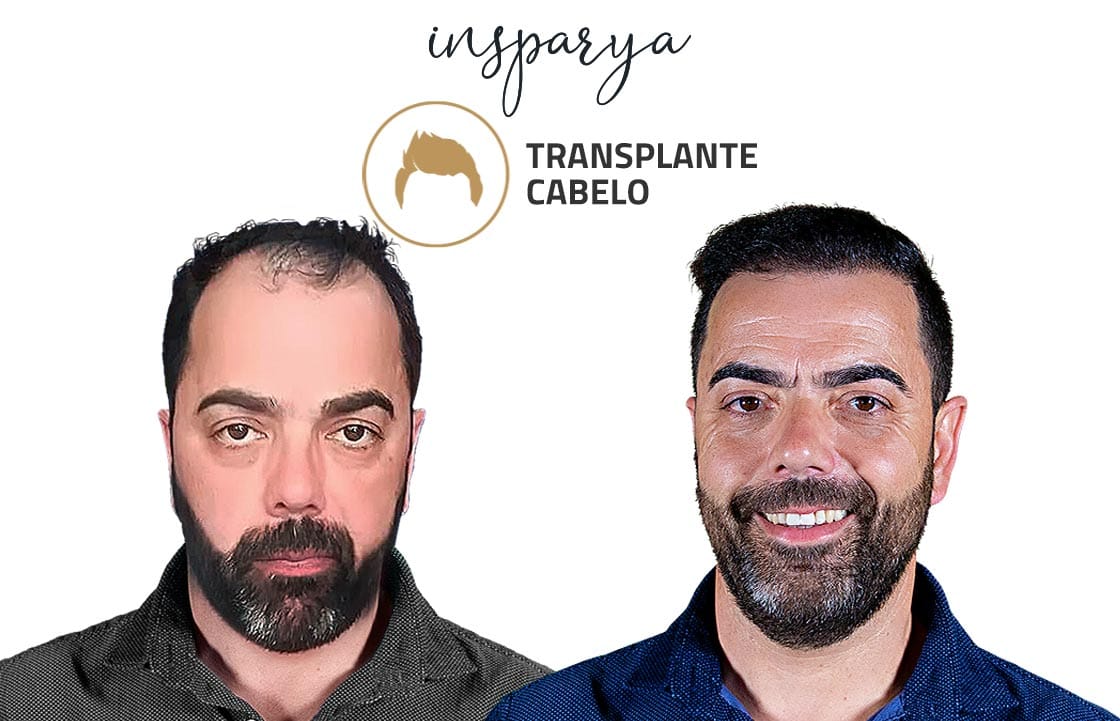 Transplante Capilar Antes e Depois, Manuel Teixeira