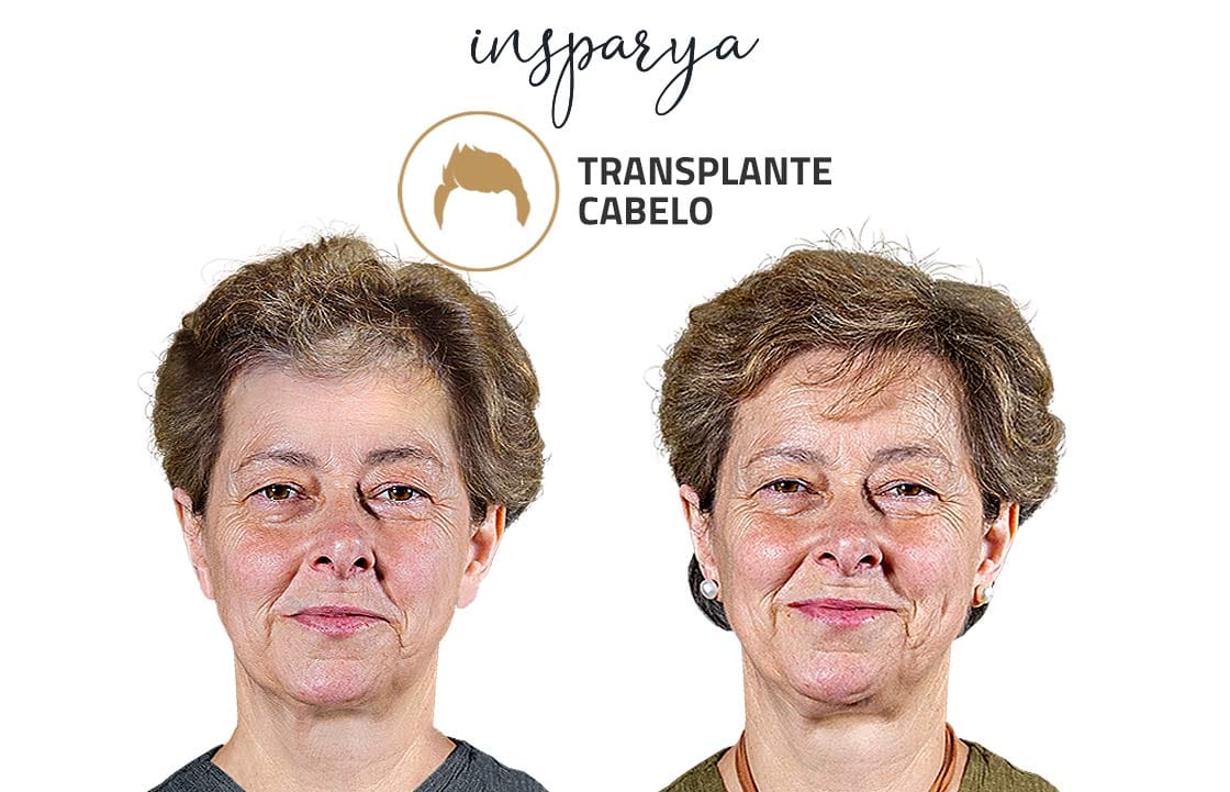 Transplante Capilar Antes e Depois, Maria Amado