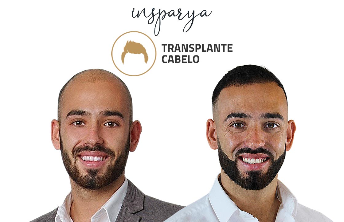 Transplante Capilar Antes e Depois, Micael Rocha