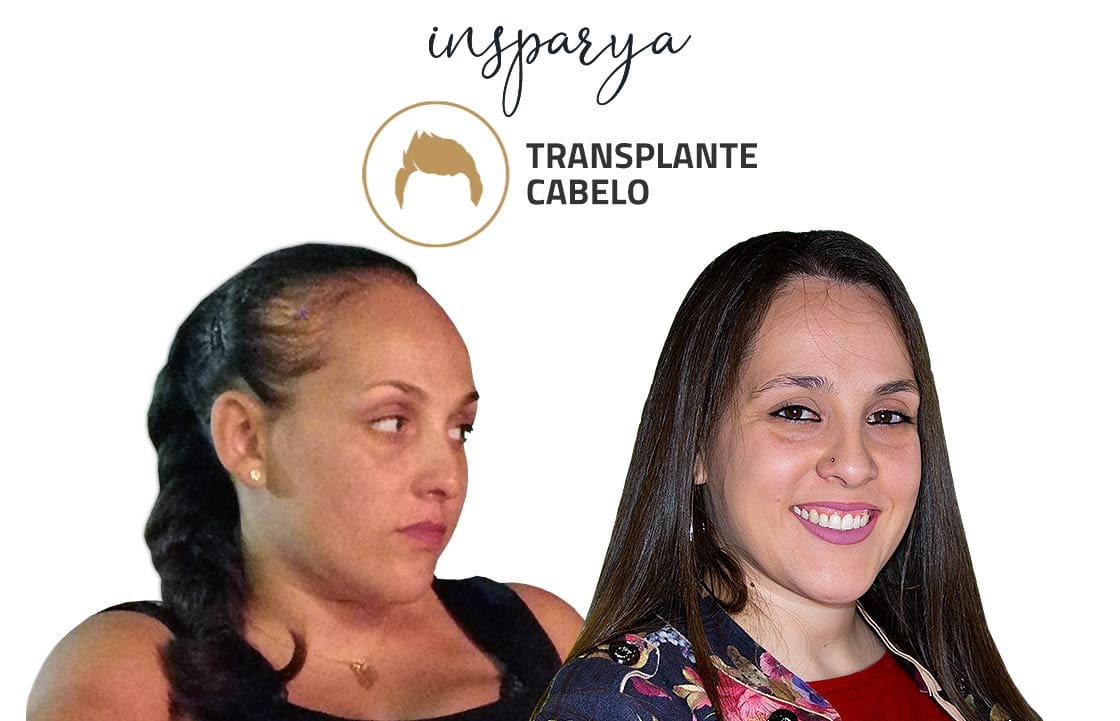 Neuza Pereira – Transplante Capilar, Antes e Depois Transplante Capilar Antes e Depois, Carlos Martins