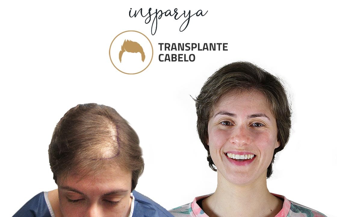 Nicole Barroso – Transplante Capilar, Antes e Depois Transplante Capilar Antes e Depois, Tiago Caeiro
