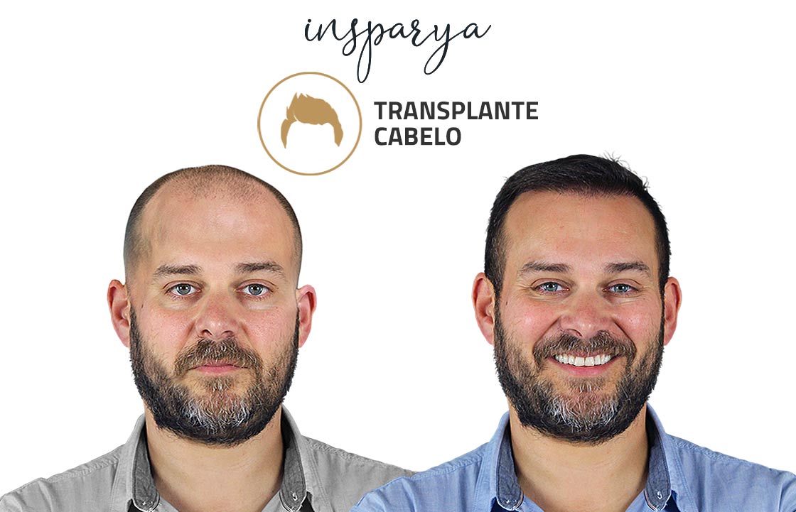 Transplante Capilar Antes e Depois, Carlos Martins