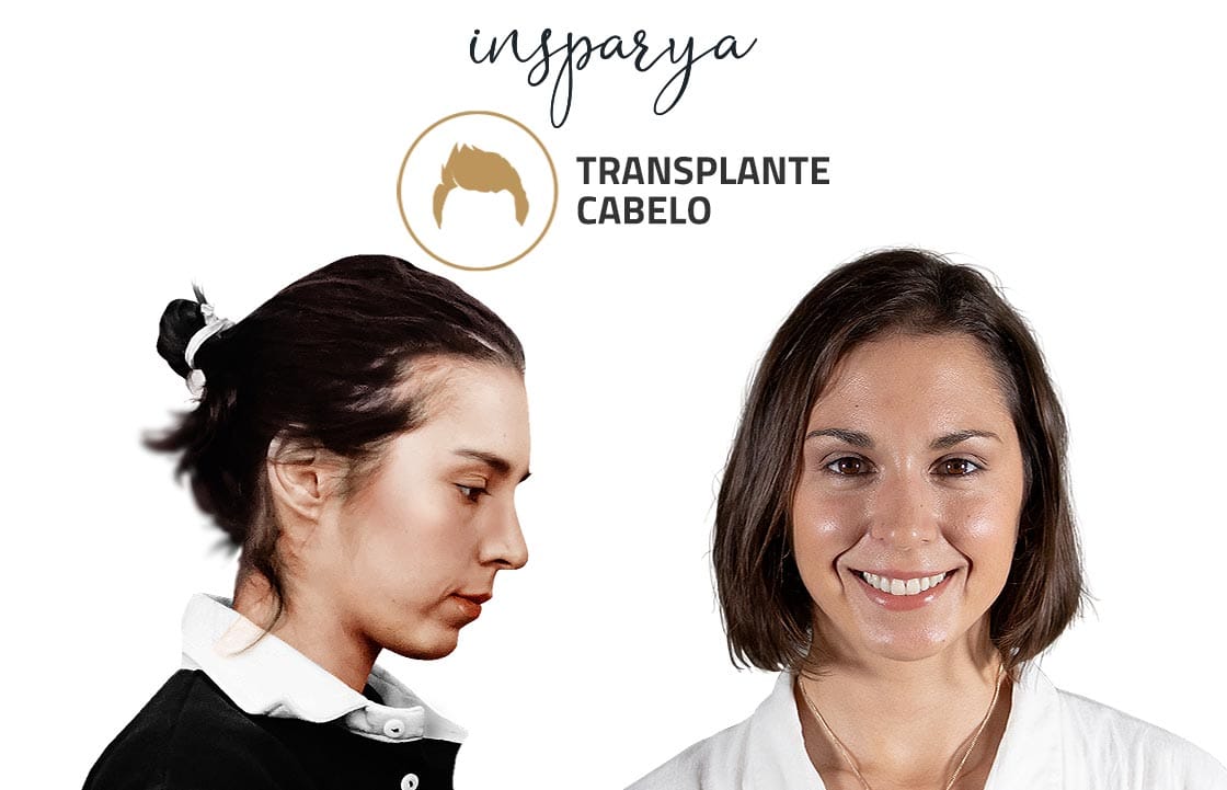 Patricia Marques – Transplante Capilar, Antes e Depois Transplante Capilar Antes e Depois, Tiago Caeiro