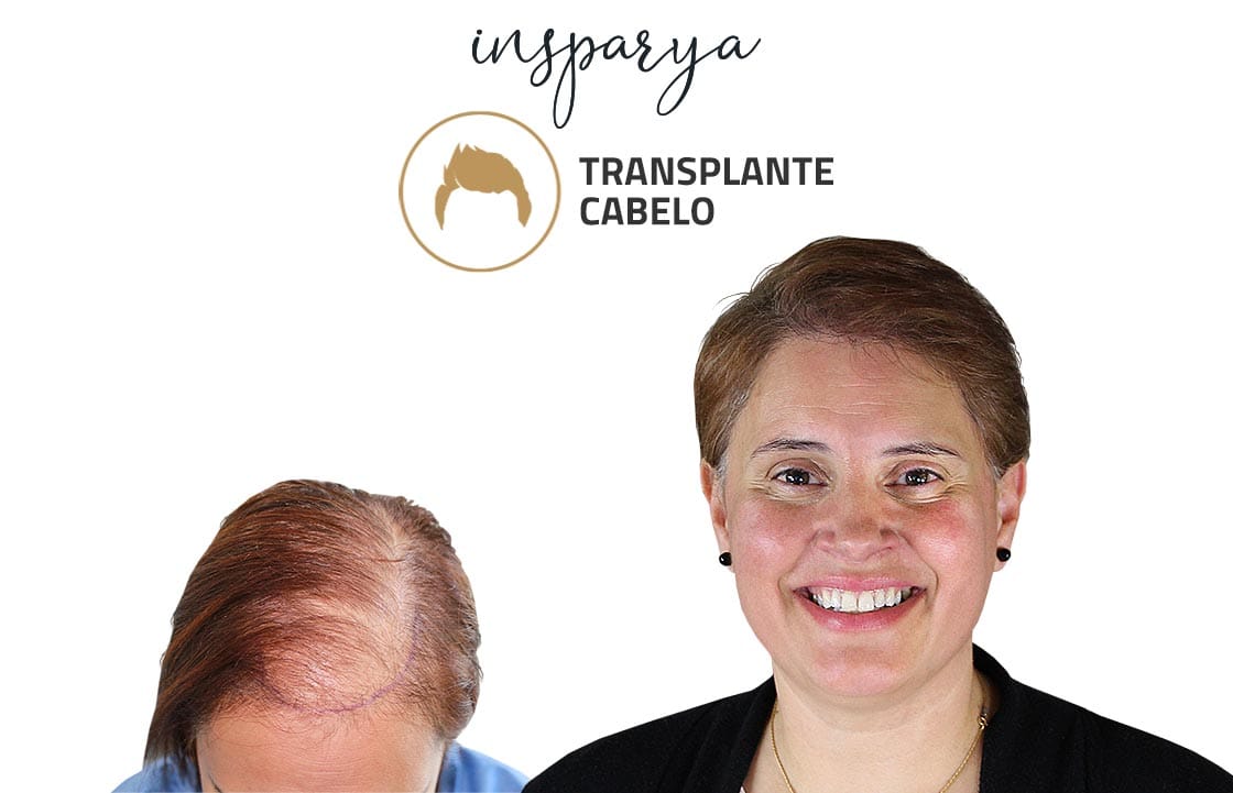 Patricia Silva – Transplante Capilar, Antes e Depois Transplante Capilar Antes e Depois, Valter Carvalho