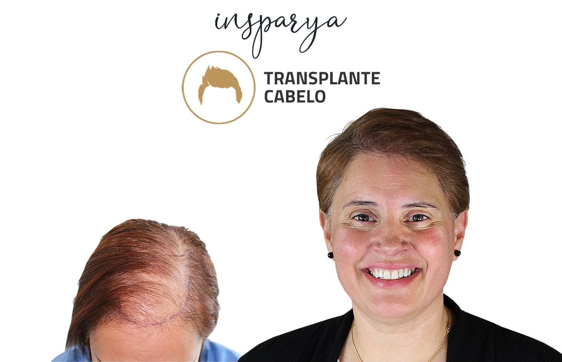 Transplante Capilar Antes e Depois, Valter Carvalho