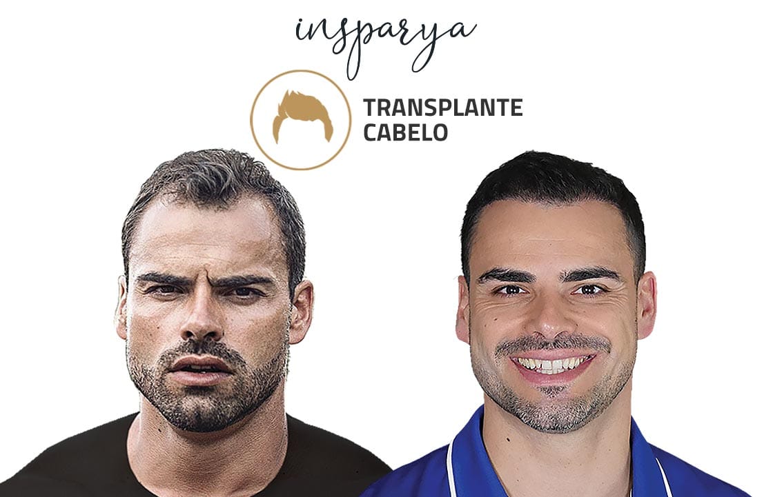 Transplante Capilar Antes e Depois, Santiago