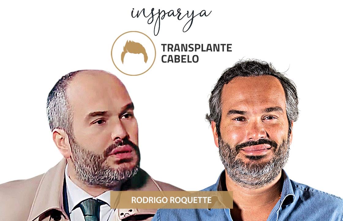 Transplante Capilar Antes e Depois, Bosingwa