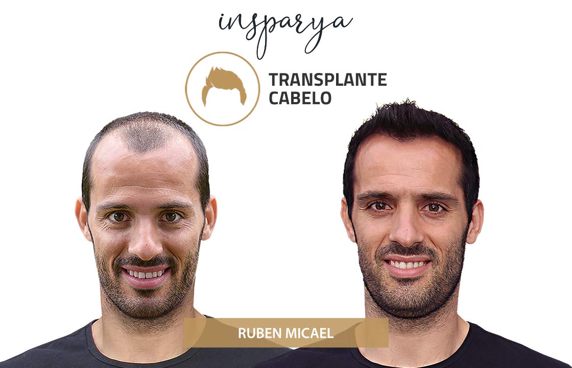 Transplante Capilar Antes e Depois, Raúl Meireles