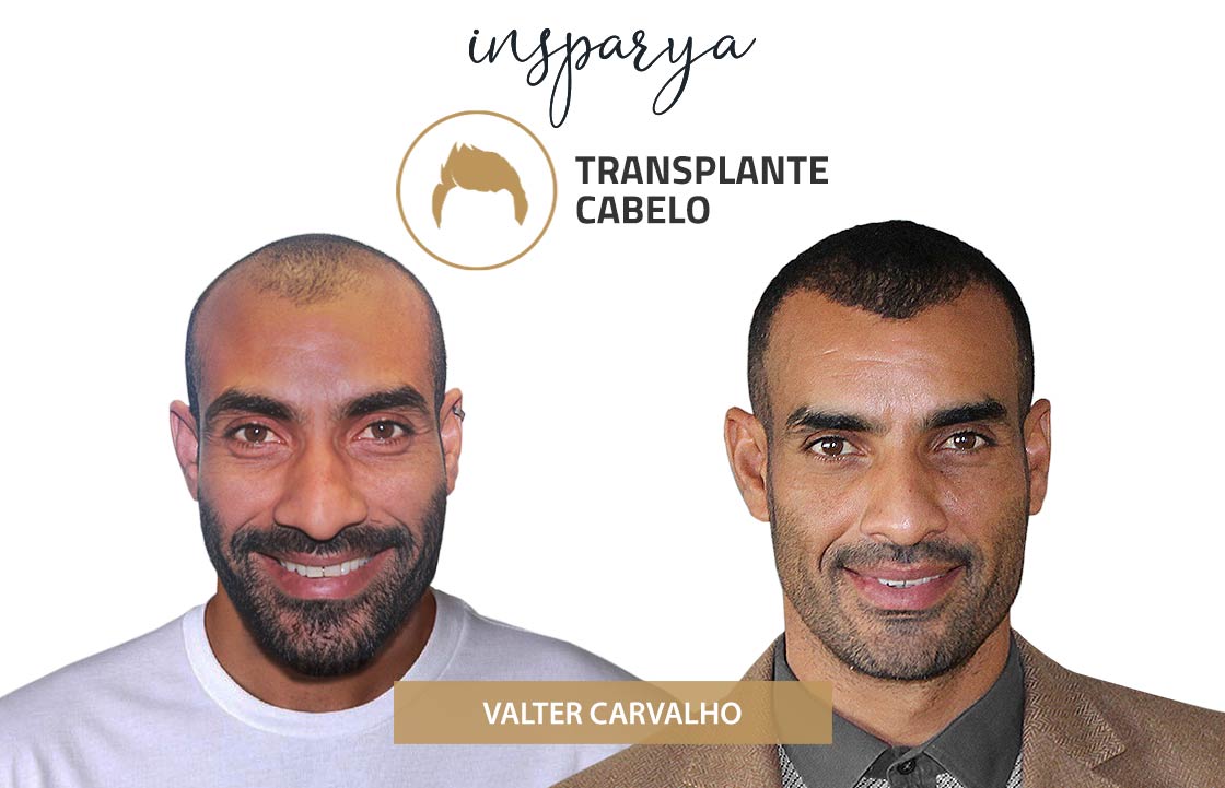 Transplante Capilar Antes e Depois, Alexandre Pimenta