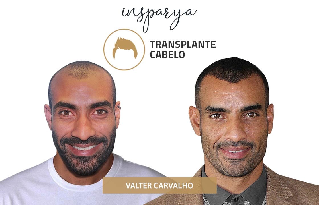 Valter Carvalho – Transplante Capilar, Antes e Depois Transplante Capilar Antes e Depois, Alexandre Pimenta