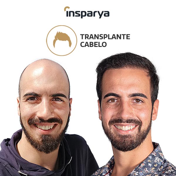 Transplante Capilar do Tiago Tavares