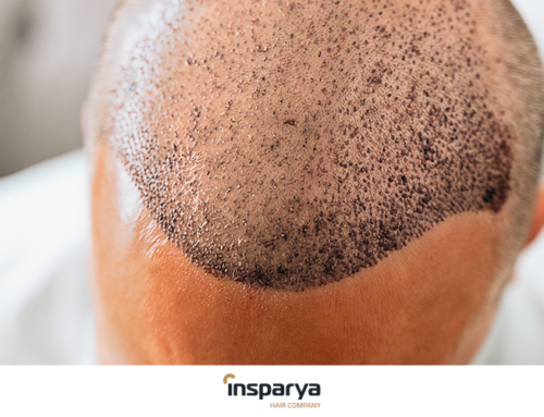 Manutenção do cabelo antes e depois de um transplante capilar