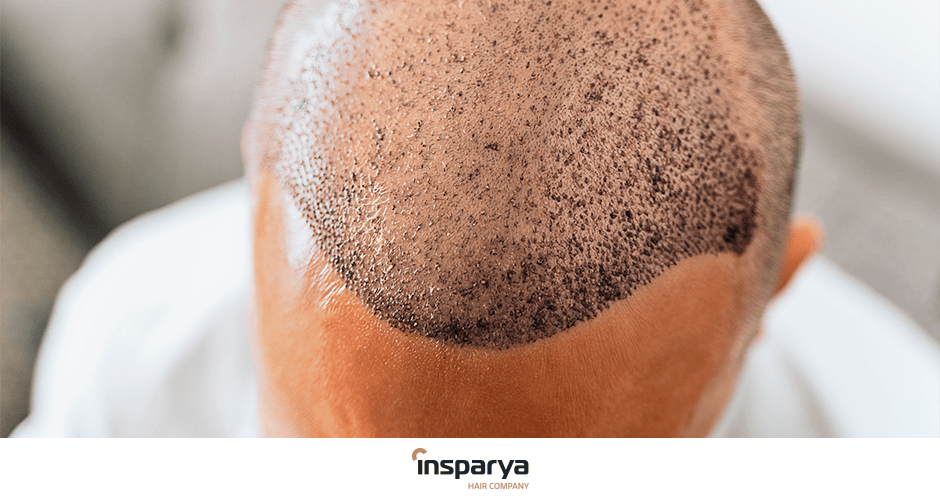 Minoxidil Insparya