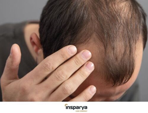 Alopécia: Quais as causas, sintomas e tratamentos eficazes?