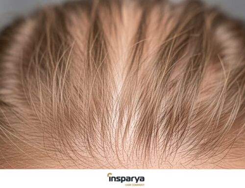 Cabelo fino ou perda de densidade: como diferenciá-los e o que fazer em cada caso