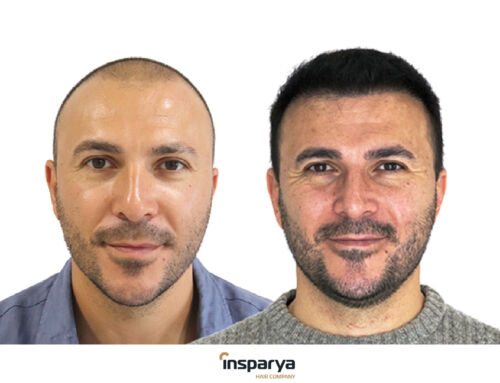 Antes e depois do transplante capilar na Insparya: resultados reais que marcam a diferença 